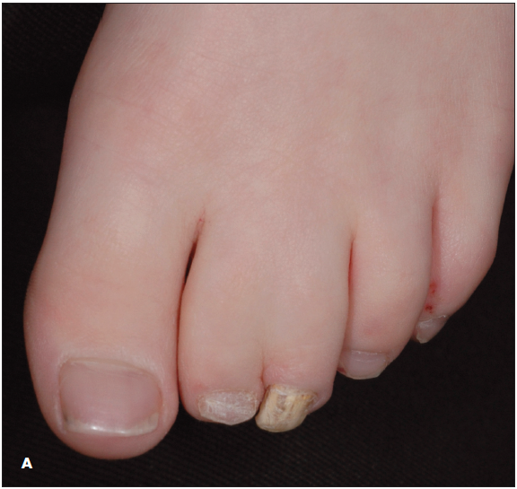 Two girls present with toenail yellowing and thickening Consultant360